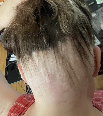 My Experience With Ophiasis Alopecia So Far My Experience With Ophiasis Alopecia So Far