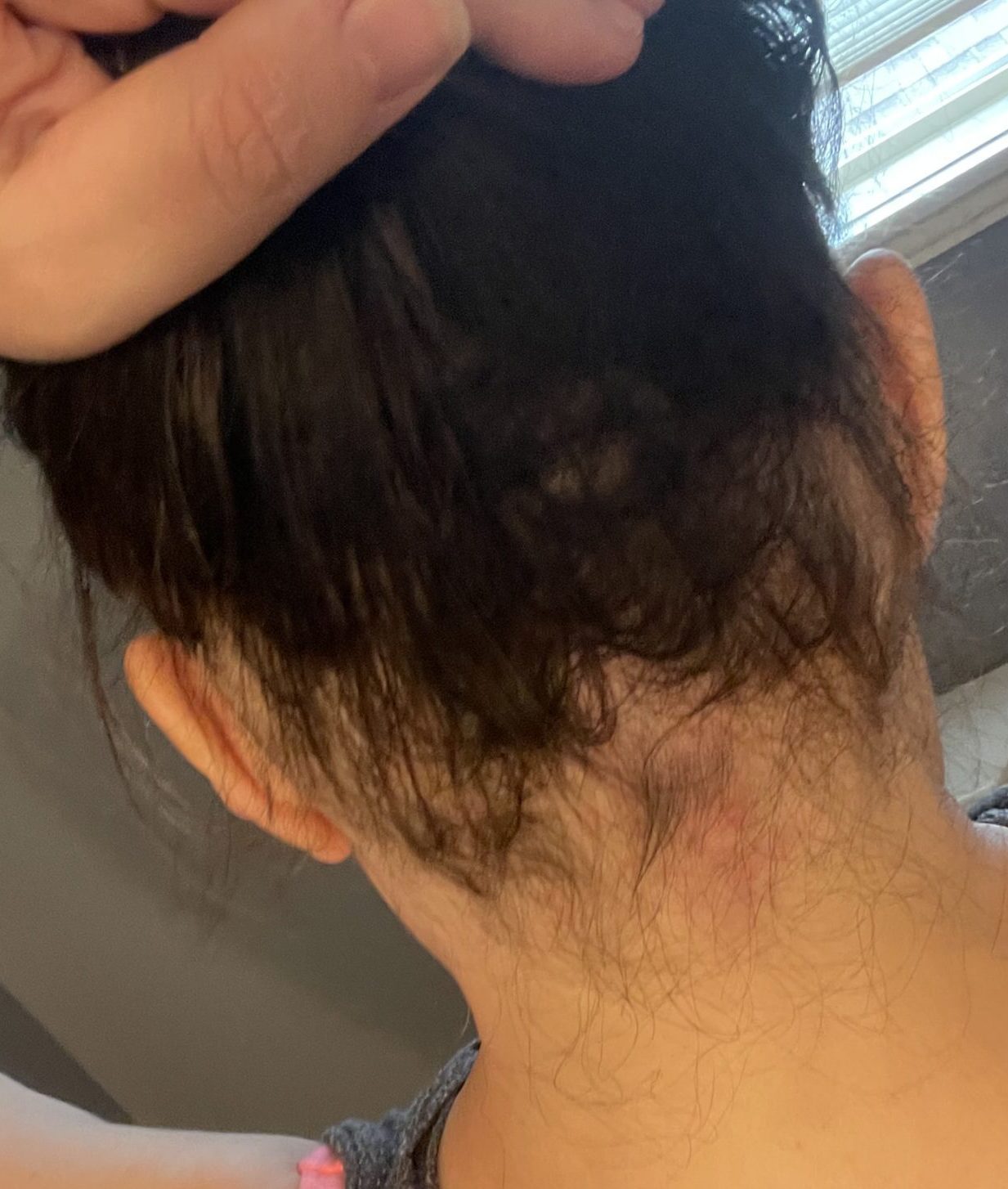 Ophiasis Alopecia Update: End Of May To End Of August