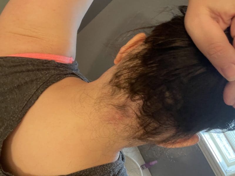 Ophiasis Alopecia Update: End Of May To End Of August Ophiasis Alopecia Update: End Of May To End Of August