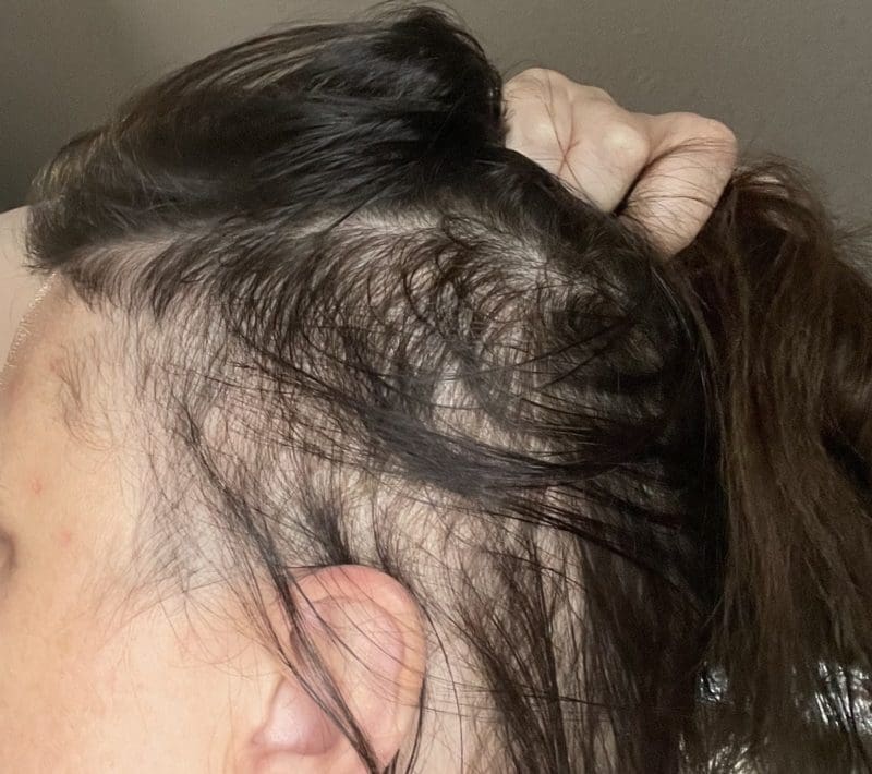 Alopecia Ophiasis Hair Growth Left
