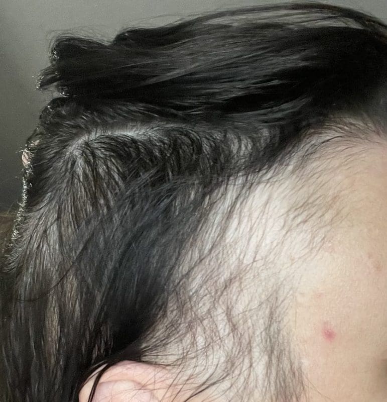 Alopecia Ophiasis Hair Growth Right