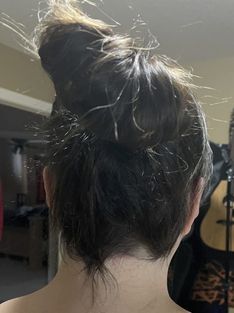 Ophiasis Alopecia Update: End Of August To Middle Of December Ophiasis Alopecia Update: End Of August To Middle Of December